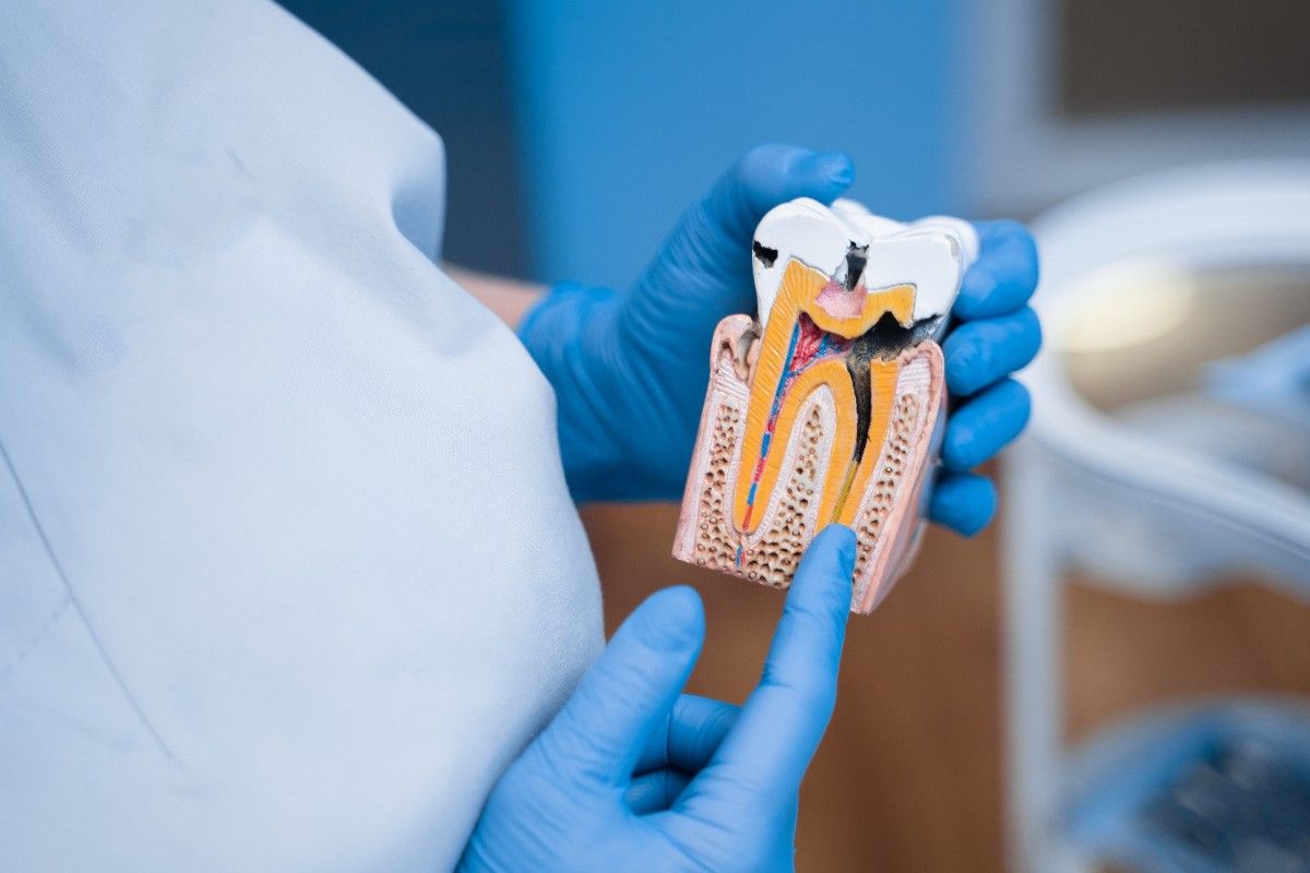 dummy-sick-tooth-with-caries-dentist-shows-structure-teeth (1)