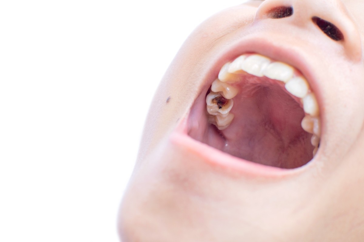 midsection-girl-showing-damaged-tooth-against-white-background (1)