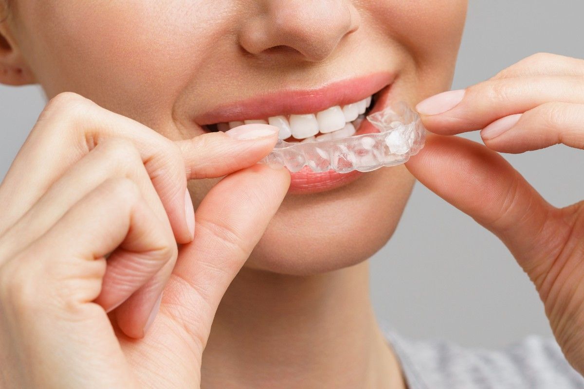 young-woman-does-home-teeth-whitening-procedure-whitening-tray-with-gel (1)
